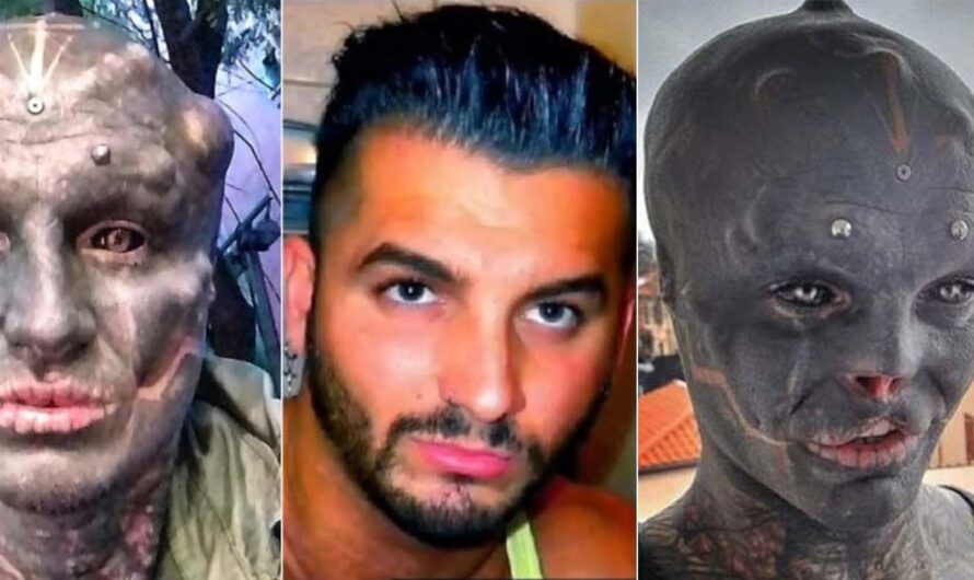 ശരീരഭം​ഗി വർദ്ധിപ്പിക്കാൻ മൂക്കും മേൽച്ചുണ്ടും നീക്കം ചെയ്തു.